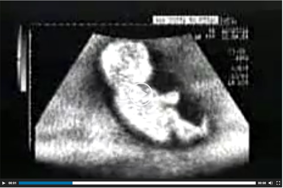 stradini born